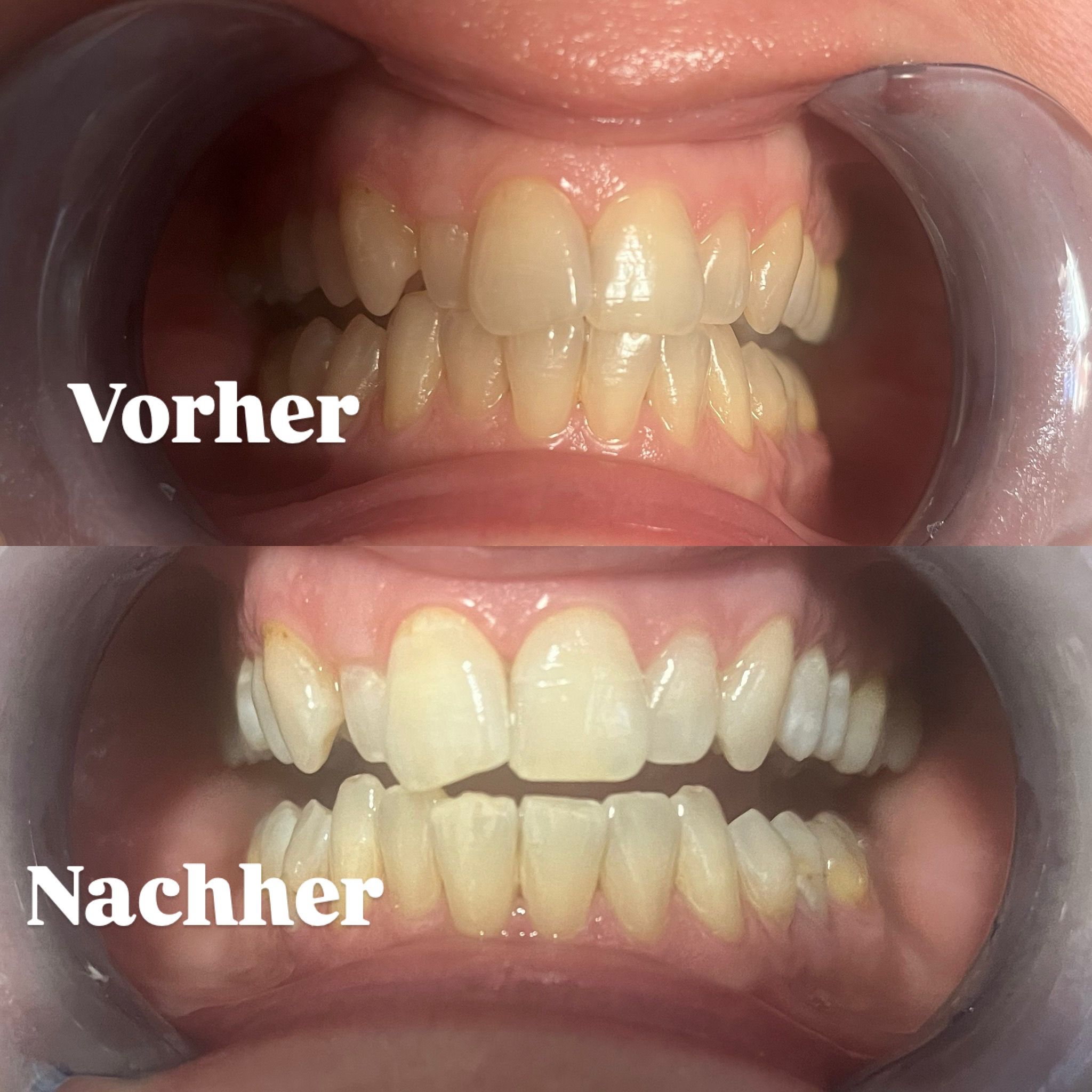 Zahnbleaching
